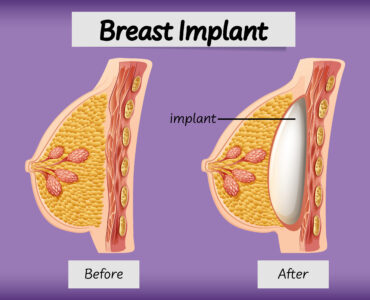 Breast Implant