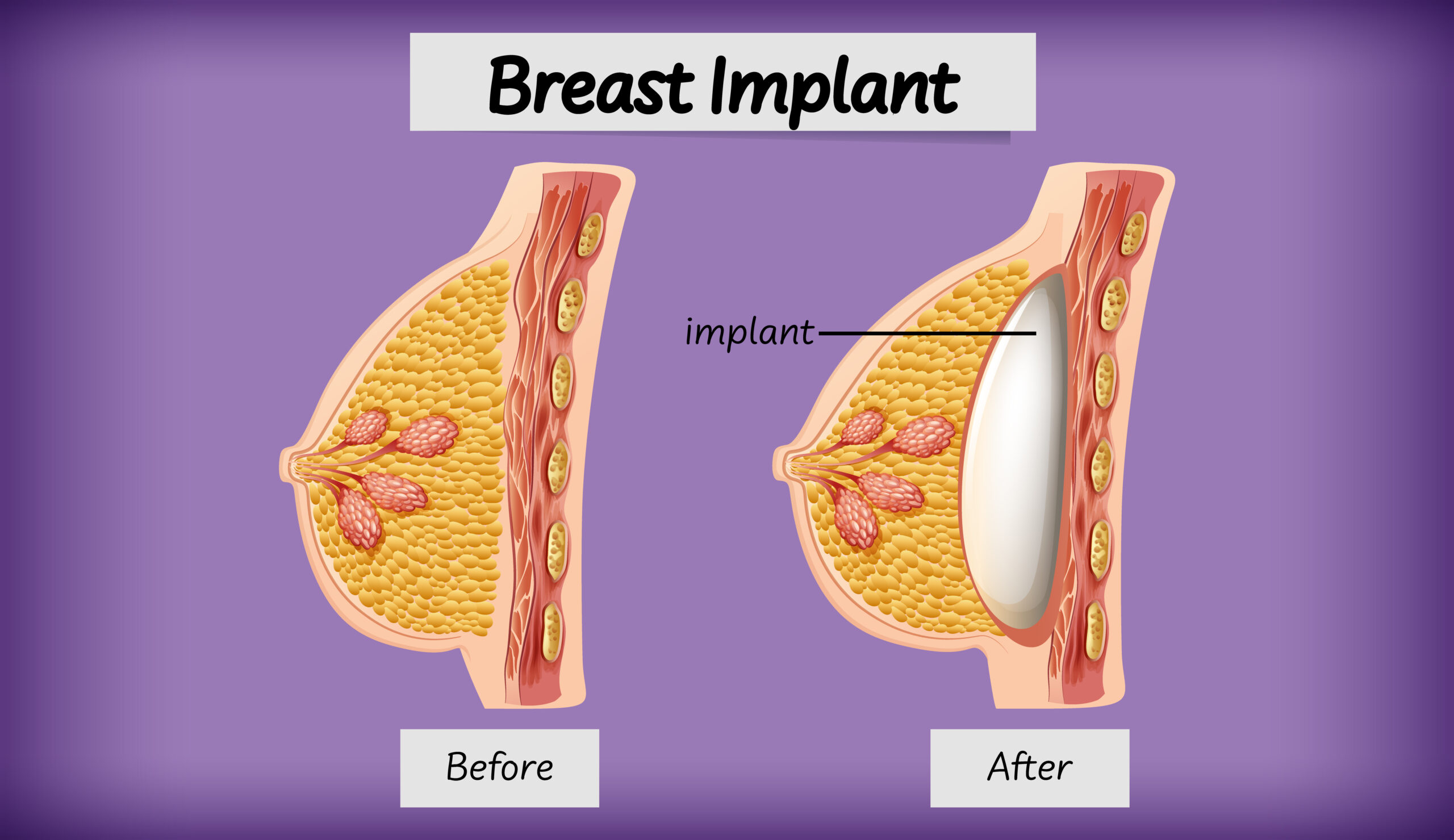 Breast Implant