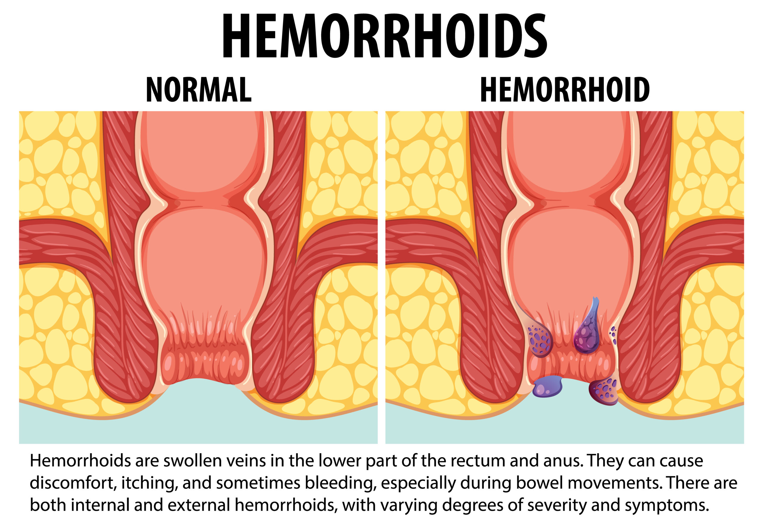 hemorrhoids