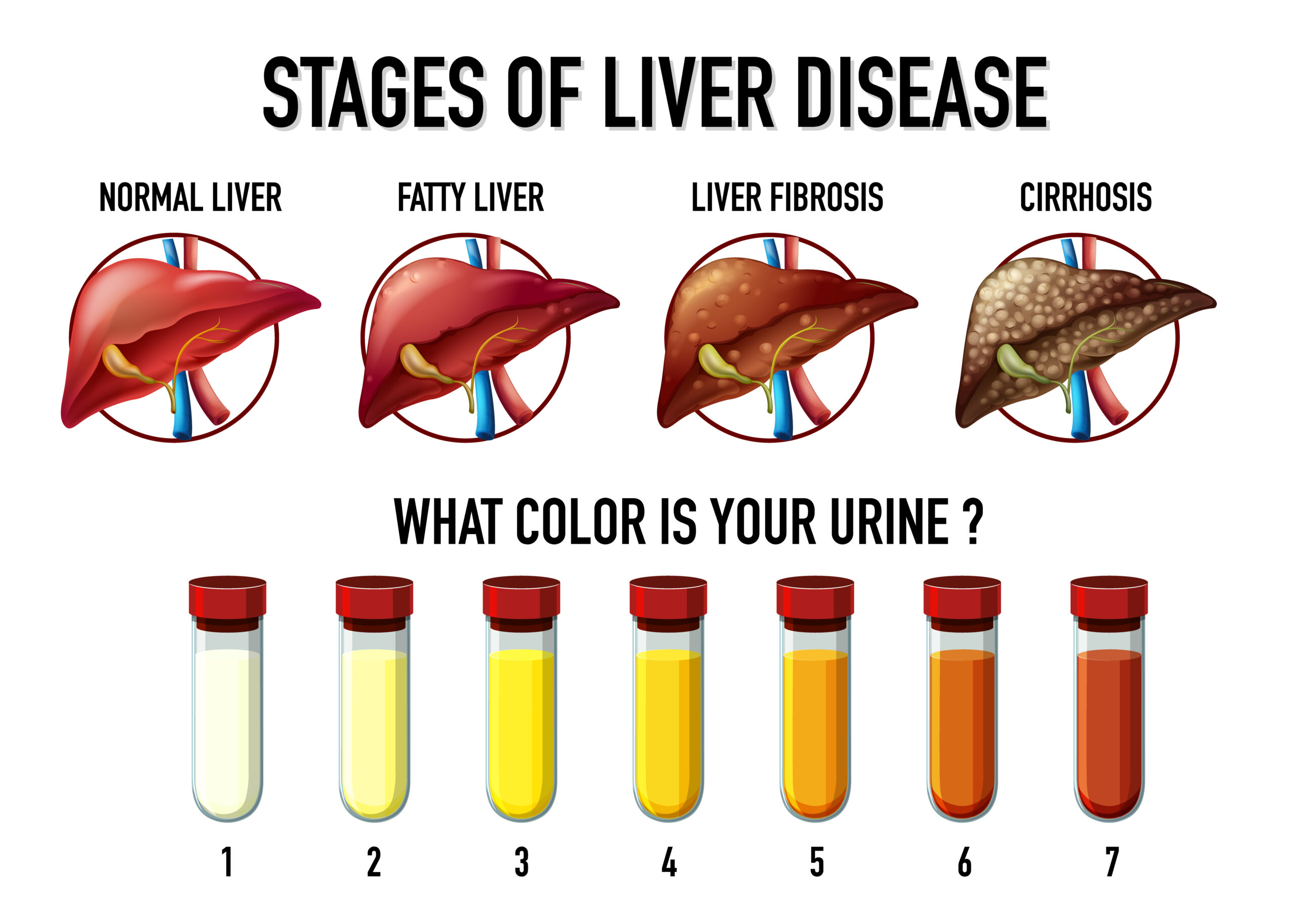 Stages of Liver Disease