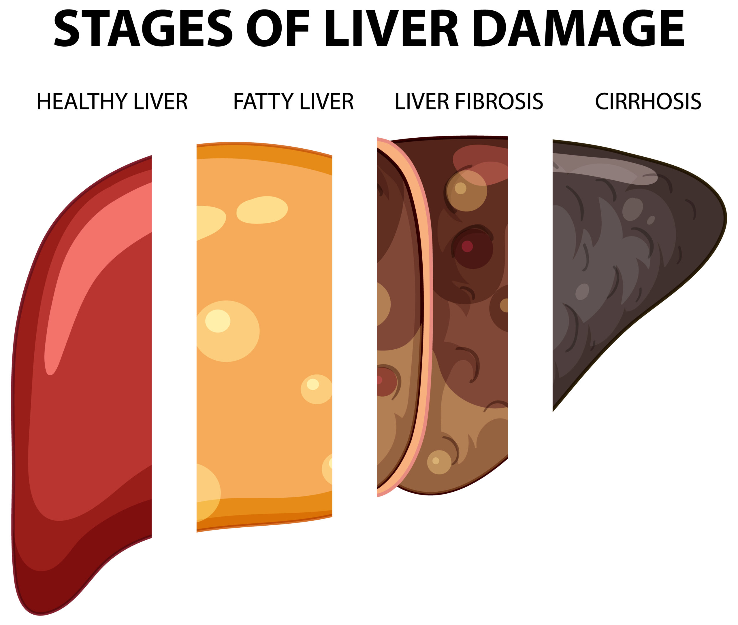 Fatty Liver