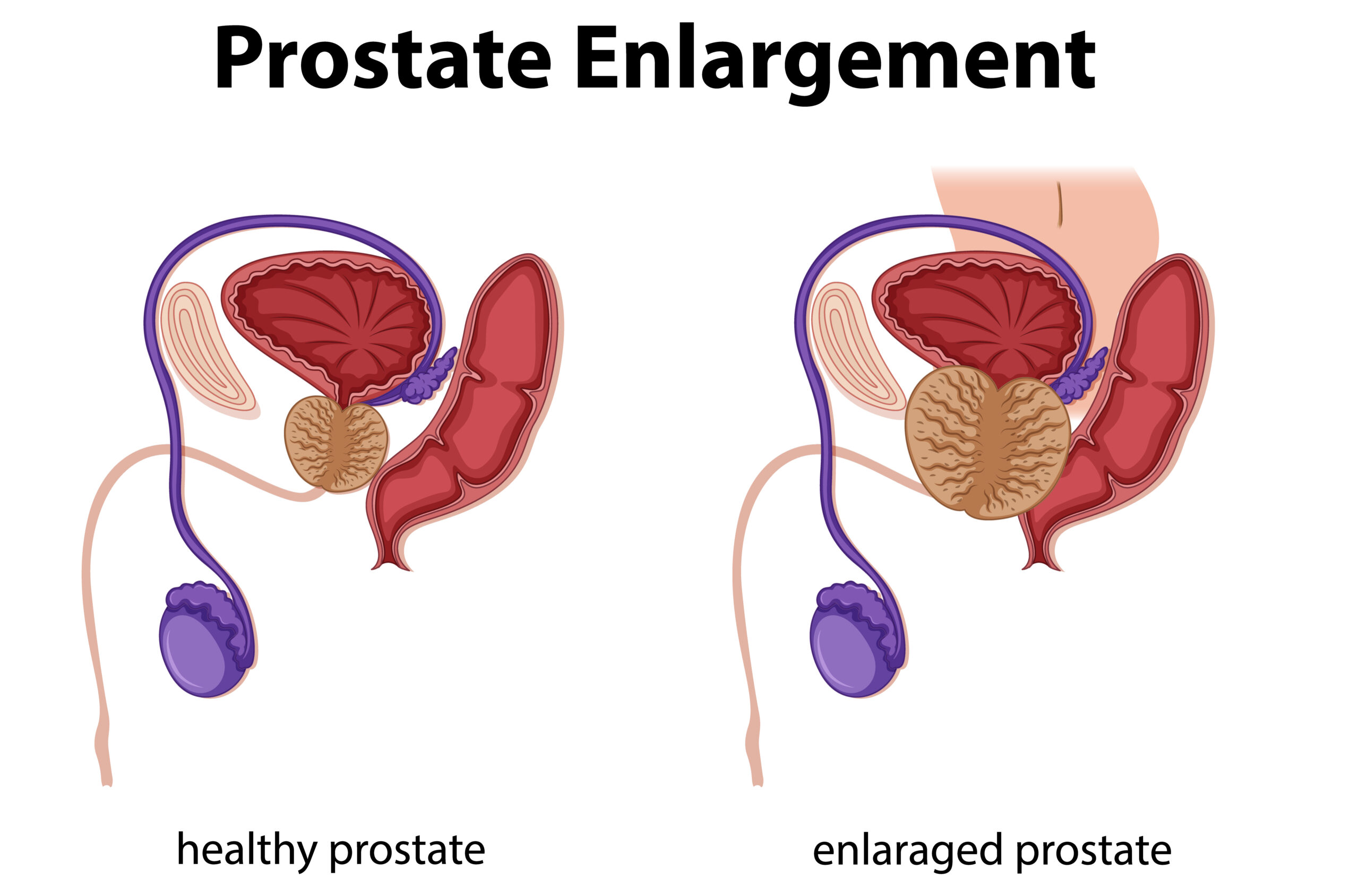 Prostate Enlargement