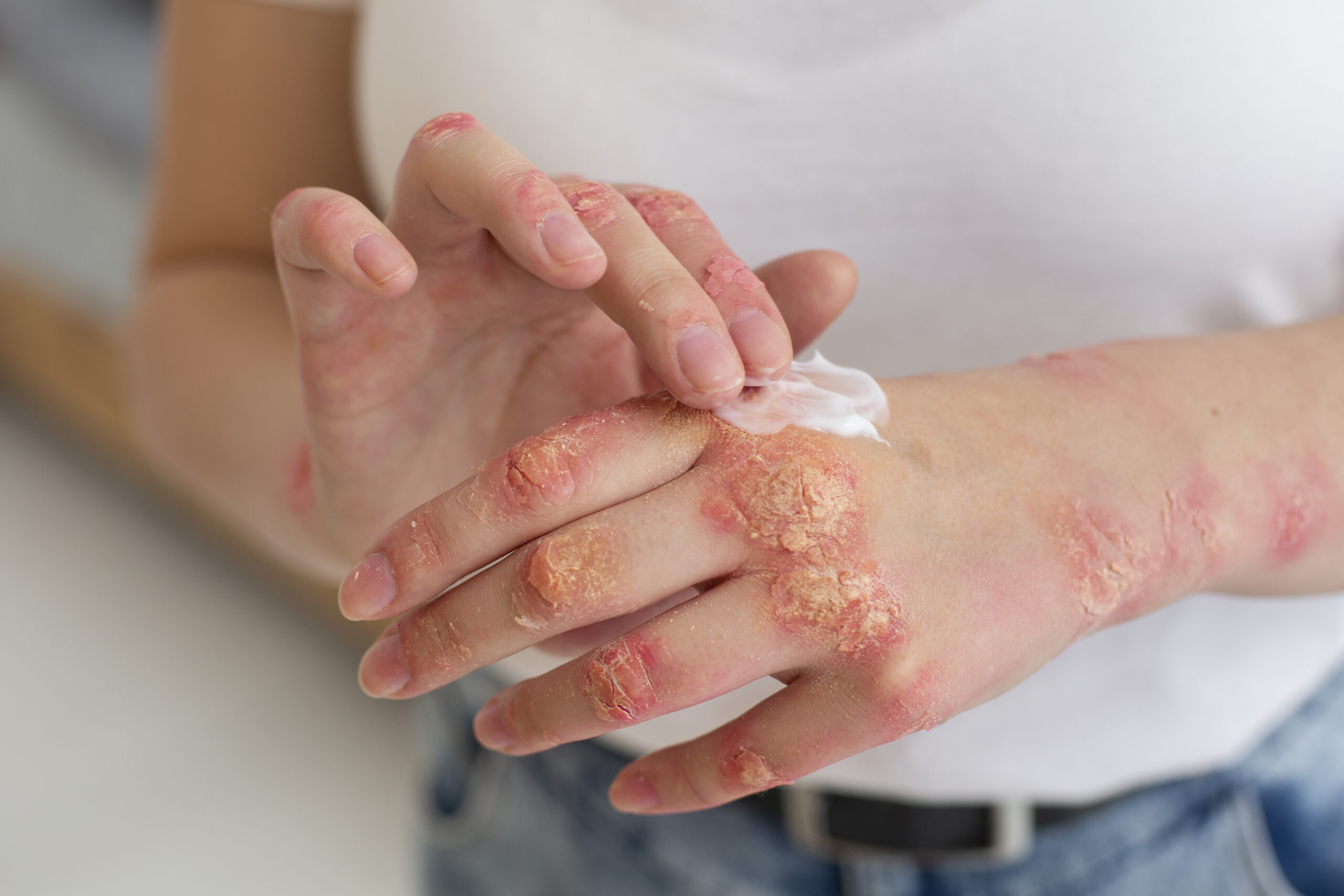 Psoriasis